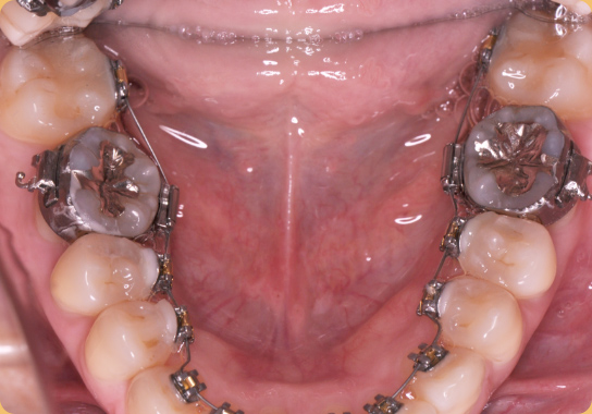 舌側矯正（下顎）