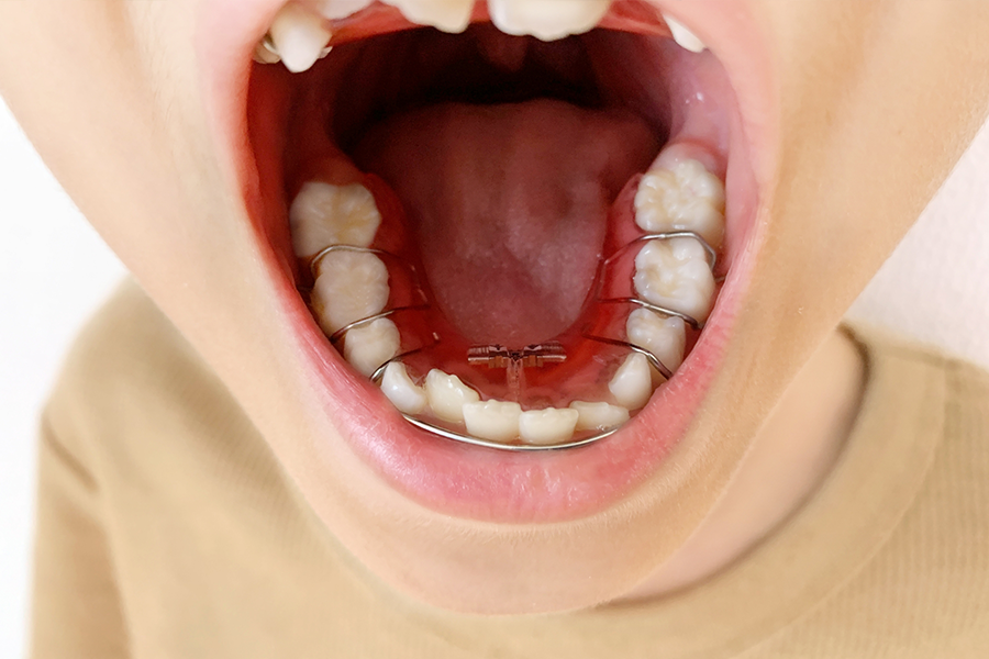 長崎県長崎市で小児矯正をお考えの方へ